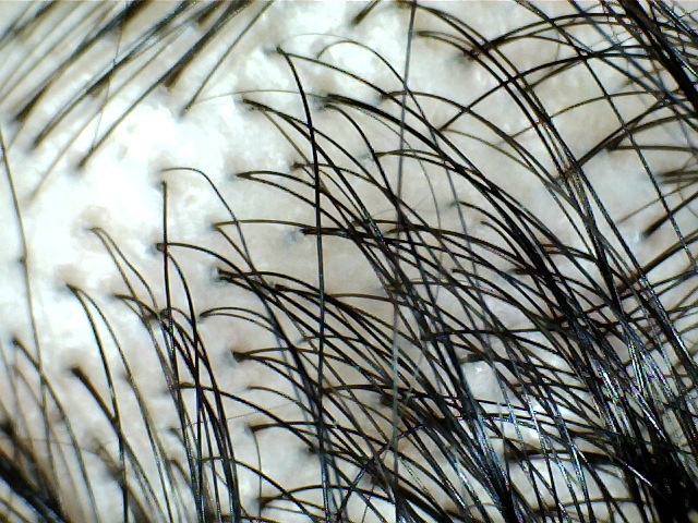 Top 10 myths about hair transplants