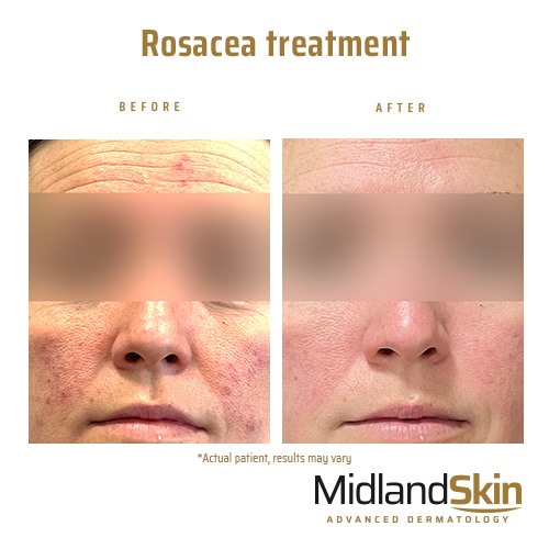 Rosacea treatment at Midland Skin Birmingham