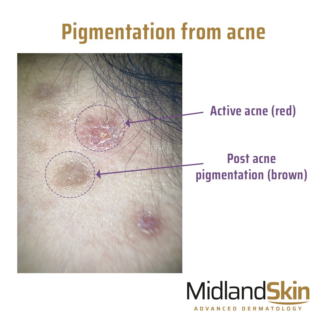 Example of active acne which is red, and hyperpigmentation caused by acne which is brown