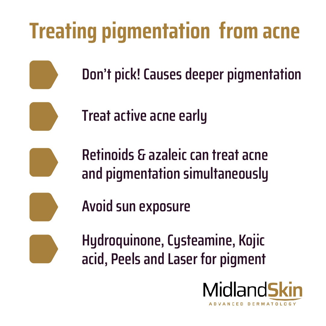 Treatment of pigmentation caused by acne